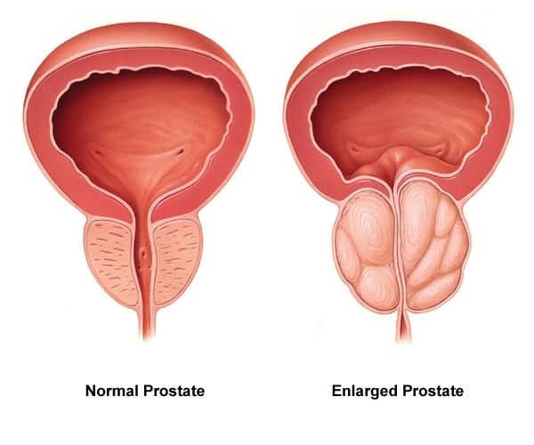normální a zvětšená prostata