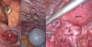 endometrióza, laparoskopický snímek
