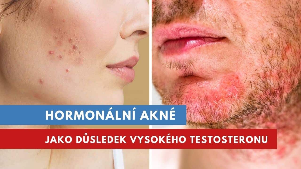 Jak ovlivnit hormonální akné?