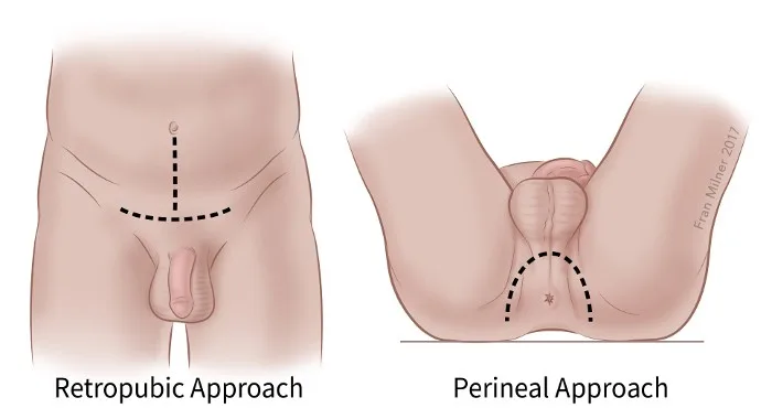 typy otevřené prostatektomie