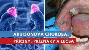 Addisonova choroba