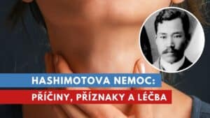 hashimotova nemoc