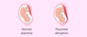 abrupce placenty v těhotenství