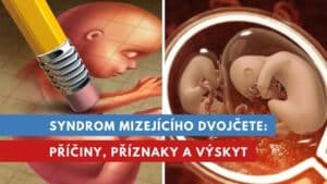 syndrom mizejícího dvojčete