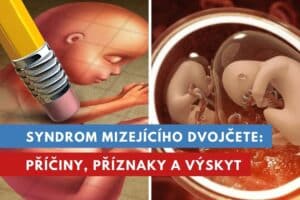 syndrom mizejícího dvojčete