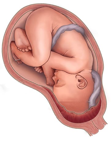 úplná placenta previa