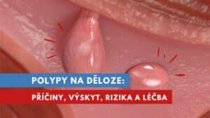 polypy v děloze